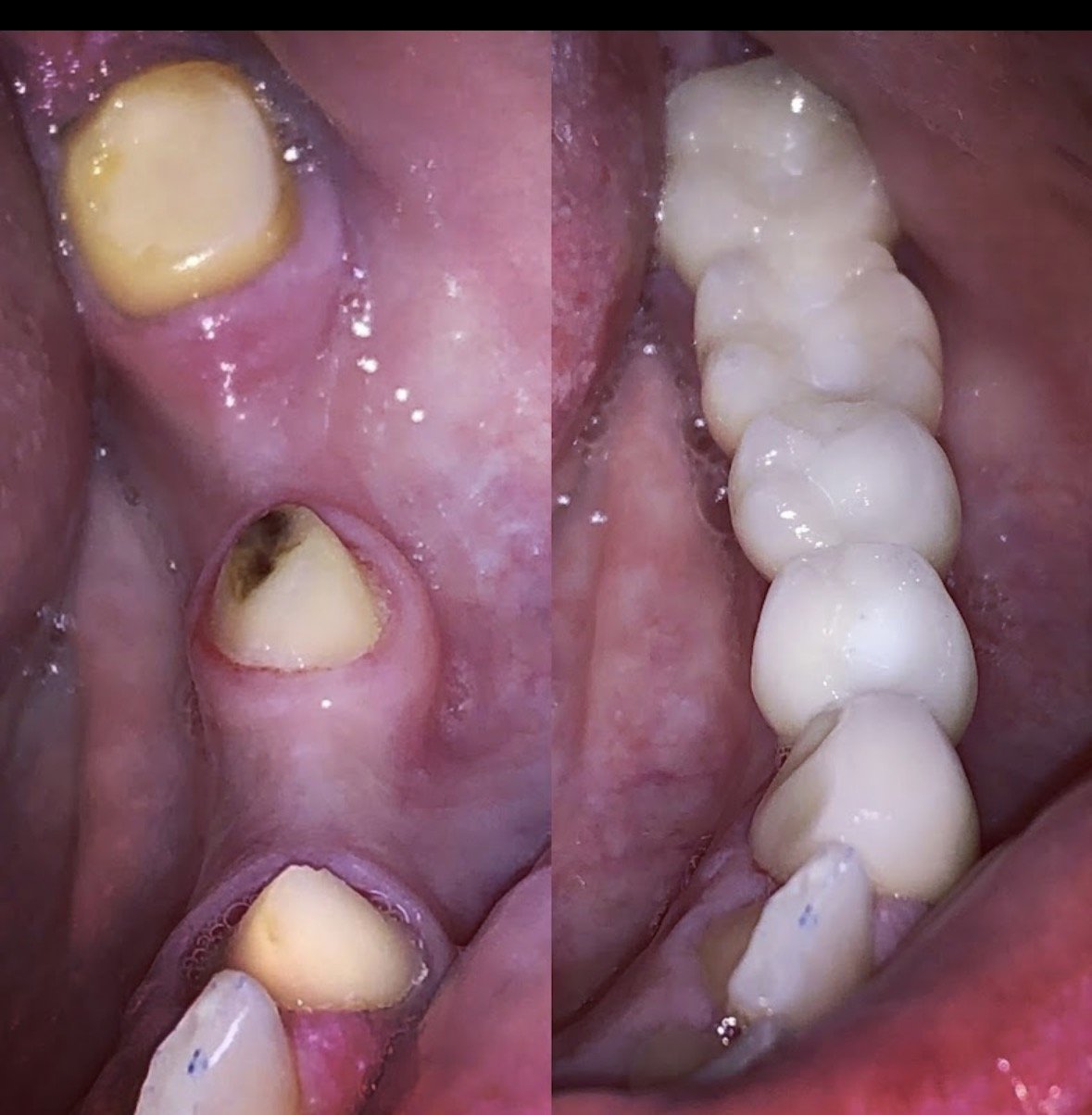 Before and after photo of dental crown work